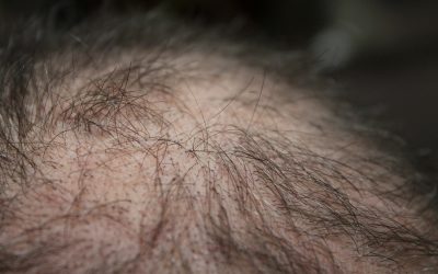 Les facteurs qui ont un impact sur le coût d’une greffe de cheveux ?